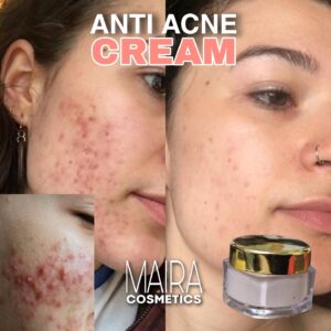ANTI ACNE and PIMPLE CREAM 30gm